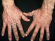 Irritant Contact Dermatitis in Adults: Condition, Treatments, and Pictures - Overview | skinsight