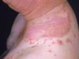 This image displays a severe case of irritant dermatitis.