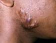 Keloids often form in areas of acne on the cheeks and trunk.