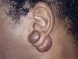 When the ear is pierced, lumpy keloids may occur on both sides of the earlobe.