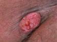 This image displays a larger keratoacanthoma occurring in a skin fold.