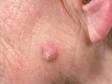 A keratoacanthoma appears on sun-damaged skin and typically has a red, firm base and central crust-like ?plug.?