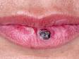 This image displays a keratoacanthoma on the lip.