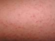 This image displays tiny, scaly elevations of the skin around the hair follicle typical of keratosis pilaris.