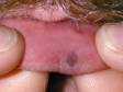 A lentigo on the lip is a flat, light brown spot, usually found on the lower lip, where sun exposure is more common.