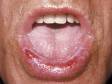Lichen planus can cause erosions of the lips.