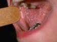 Net-like, white, slightly elevated lesions inside the mouth are typical of oral lichen planus.