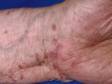 This image displays typical flat-topped, purple (violaceous) elevations of the skin at the wrist in lichen planus.