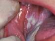 As displayed in this image, lichen planus is typically seen as white patches on the sides of the mouth lining.