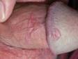 This image displays red-to-purple raised lesions typical of lichen planus on the penis.