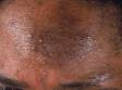 As displayed in this image, chronic rubbing and scratching can lead to darkening of the skin as well as skin thickening.