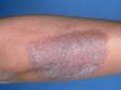This image displays scaly skin due to lichen simplex chronicus.