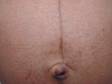 Linea nigra is typically seen in pregnant women as a sharp vertical, flat, dark line in the middle of the stomach.
