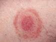 The rash of Lyme disease typically consists of a red or pink circle, or sometimes a ring within a ring appearing like a bull's-eye.