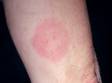 Lyme disease frequently presents as a red or pink circle that is short-lived, sometimes disappearing before the rash is noticed by the person affected.