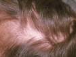 This man has worsening male-pattern hair loss resulting from the medication Tenormin.