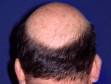 This image displays typical male pattern balding at the entire top of the scalp.