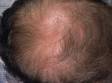 This image displays typical male-pattern balding with thinning at the top of the scalp.