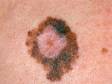 This image displays a multi-colored (including black) lesion with an irregular shape and scalloped borders typical of melanoma.