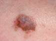 This image displays a brown, blue-gray, and pink lesion with an irregular border typical of early melanoma.