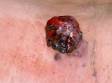 This image displays a round, bleeding melanoma that has a small "satellite" tumor underneath it.