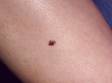 Small, but irregular, black and brown pigment is a sign of a melanoma, a serious skin cancer. Any new pigmented, itching, bleeding, or changing moles should be checked by your doctor.