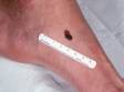 This image displays a darkly pigmented lesion typical of melanoma.