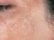 In this image, melasma is on the cheeks and extends to the temple.