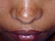 Sun-exposed areas of the face can be affected by melasma, seen on the nose and upper lip in this young woman.