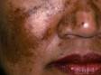 This image displays extensive irregular areas of melasma across the cheeks, nose, and chin.
