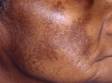 Melasma is particularly noticeable in people with darker skin.