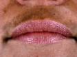 A frequent location for the increased darkness (pigmentation) seen in melasma is the upper lip.