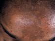As displayed in this image, melasma, while usually affecting the cheeks and lips, can also appear on the forehead.