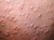 This close-up image exemplifies the smooth, red skin lesions typical of miliaria rubra.