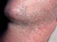 Miliaria rubra is the medical term for "prickly heat." Typically there are hundreds of small, itchy bumps as seen here.
