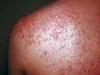 Heat Rash or Prickly Heat (Miliaria Rubra) in Adults: Condition, Treatments, and Pictures - Overview | skinsight