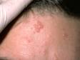 Molluscum contagiosum is caused by a common poxvirus. Associated with the virus, firm, skin-colored, pus-filled lesions with a central depression are typically present.
