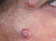 This image displays multiple large molluscum lesions on an immunocompromised patient.