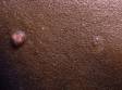 Molluscum contagiosum is a superficial poxvirus infection of the skin with lesions that can vary in size but are typically larger than a dime in diameter.