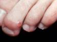 Myxoid cysts can occur on the toes.