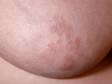 Close-up of scaly, slightly elevated lesions on the areola in nipple dermatitis.
