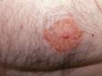 This image displays dermatitis affecting the nipple of a man.