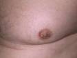 In nipple dermatitis, there is dryness and scaling over the nipples. 