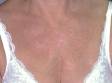 There are subtle light pink round, scaling patches of nummular dermatitis on this woman?s chest.