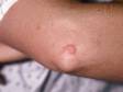 This image displays a round, pink, scaly, slightly elevated lesion typical of nummular dermatitis.