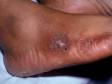 This image displays the round circles typical of nummular dermatitis.