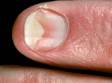 As displayed in this image, in onycholysis, the nail is lifted from the nail bed and appears white or yellow.