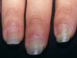 This image displays nails that have separated from the nail bed, caused by onycholysis.