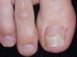 Onychomycosis often affects only the great toenail and may show separation of the plate from the nail bed as well as yellowing and thickening of the nail plate.