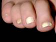 In some cases, nails can turn white as a result of onychomycosis (nail fungus infection).